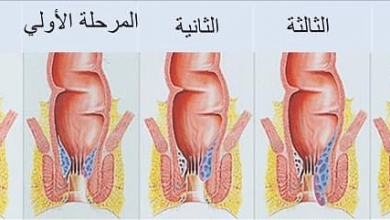 أعراض البواسير عند الرجال اكتشف العلامات المبكرة وكيفية التعامل معها بفاعلية! 5 14 13